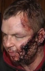 Дмитра Булатова прооперували