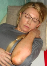 Німецькі лікарі кажуть, що Тимошенко необхідне оперативне втручання