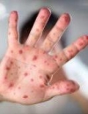 Спалах кору в Україні: рекомендації МОЗ, як запобігти захворюванню (інфографіка)